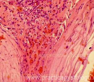 Атеросклероз коронарных артерий гистология