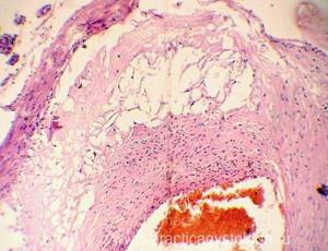 Атеросклероз аорты судан 3
