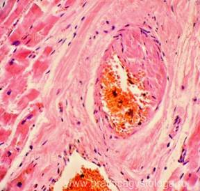 Атеросклероз коронарных артерий гистология