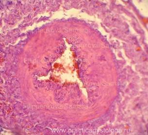 Атеросклероз аорты судан 3
