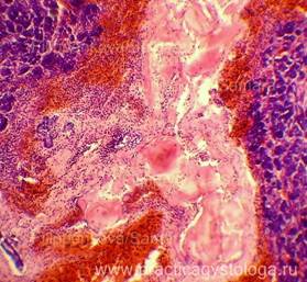Липоматоз поджелудочной железы макропрепарат описание
