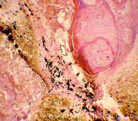 Липоматоз поджелудочной железы макропрепарат описание